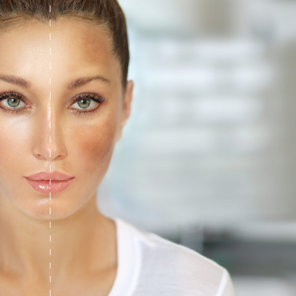 melasma brkovi, tamne nausnice