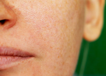 kako smanjiti proširene pore na licu