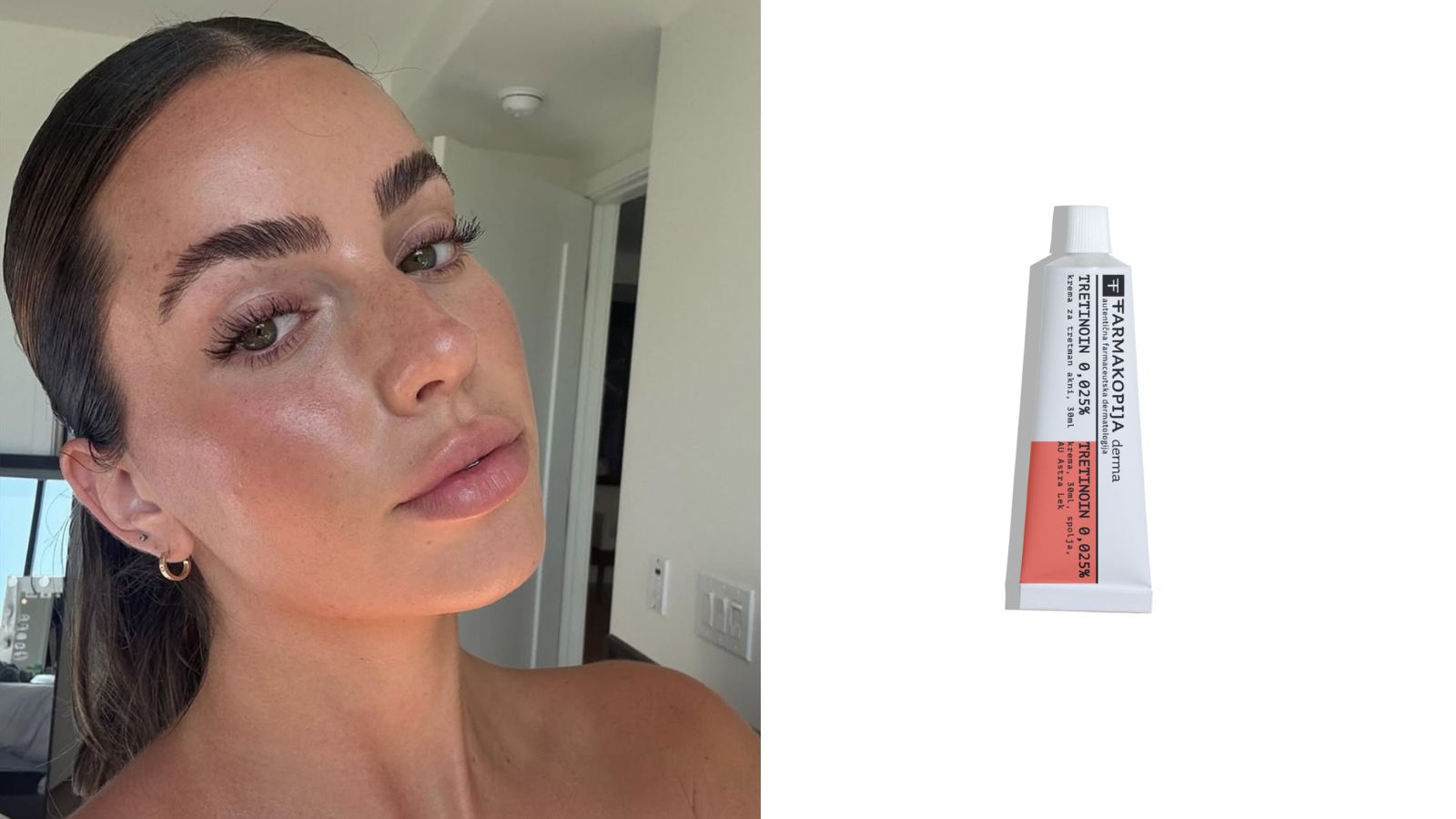 tretinoin krema (2)